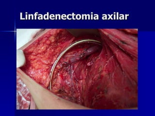 Linfadenectomia axilar 