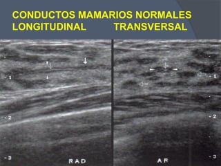CONDUCTOS MAMARIOS NORMALES
LONGITUDINAL TRANSVERSAL
 