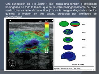 Una puntuación de 1 o Score 1 (E1) indica una tensión o elasticidad
homogénea en toda la lesión, que se muestra homogéneamente de color
verde. Una variante de este tipo (1*) es la imagen diagnóstica de los
quistes: la imagen en tres capas, producida por artefactos de
reverberación
 