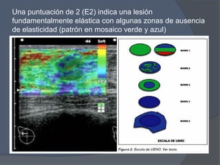 Una puntuación de 2 (E2) indica una lesión
fundamentalmente elástica con algunas zonas de ausencia
de elasticidad (patrón en mosaico verde y azul)
 