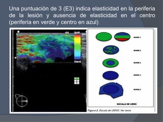 Una puntuación de 3 (E3) indica elasticidad en la periferia
de la lesión y ausencia de elasticidad en el centro
(periferia en verde y centro en azul)
 