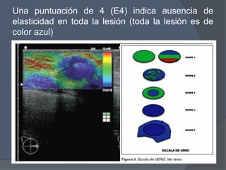 Una puntuación de 4 (E4) indica ausencia de
elasticidad en toda la lesión (toda la lesión es de
color azul)
 