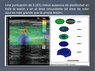 Una puntuación de 5 (E5) indica ausencia de elasticidad en
toda la lesión y en el área circundante (el área de color
azul es más grande que la propia lesión)
 