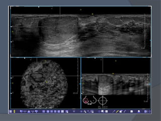 Ultrasonido de mama y  elastografía.