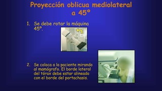 Proyección oblicua mediolateral
a 45º
1. Se debe rotar la máquina
45º.
2. Se coloca a la paciente mirando
al mamógrafo. El borde lateral
del tórax debe estar alineado
con el borde del portachasis.
 