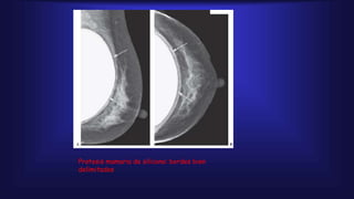 Protesis mamaria de silicona: bordes bien
delimitados
 