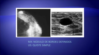 MX: NODULO DE BORDES DEFINIDOS
US: QUISTE SIMPLE
 