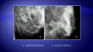 a. FIBROADENOMA b. QUISTE SIMPLE
 