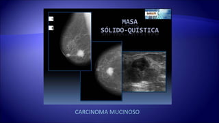 CARCINOMA MUCINOSO
 