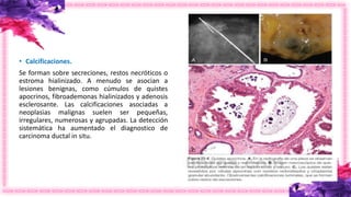• Calcificaciones.
Se forman sobre secreciones, restos necróticos o
estroma hialinizado. A menudo se asocian a
lesiones benignas, como cúmulos de quistes
apocrinos, fibroademonas hialinizados y adenosis
esclerosante. Las calcificaciones asociadas a
neoplasias malignas suelen ser pequeñas,
irregulares, numerosas y agrupadas. La detección
sistemática ha aumentado el diagnostico de
carcinoma ductal in situ.
 