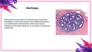 Hiperplasia ductal atípica: se reconoce por su parecido
histológico al carcinoma ductal in situ (CDIS)corresponde a
una proliferación relativamente uniforme de células
dispuesta a intervalos regulares, en ocasiones con espacios
cribiformes.
Morfología
 
