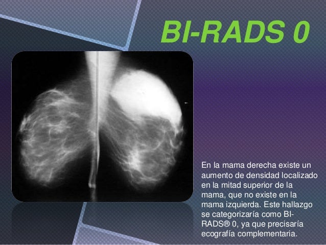 Bi Rads Y Técnicas De Imagen | Clasificacion Bi Rads 4C – OWMOVG
