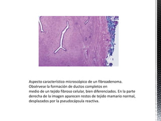 Aspecto característico microscópico de un fibroadenoma.
Obsérvese la formación de ductos completos en
medio de un tejido fibroso celular, bien diferenciados. En la parte
derecha de la imagen aparecen restos de tejido mamario normal,
desplazados por la pseudocápsula reactiva.

 