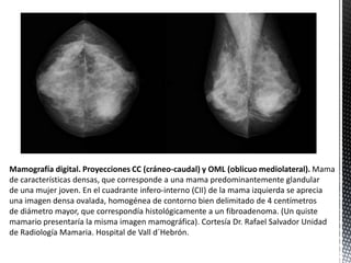 Mamografía digital. Proyecciones CC (cráneo-caudal) y OML (oblicuo mediolateral). Mama
de características densas, que corresponde a una mama predominantemente glandular
de una mujer joven. En el cuadrante infero-interno (CII) de la mama izquierda se aprecia
una imagen densa ovalada, homogénea de contorno bien delimitado de 4 centímetros
de diámetro mayor, que correspondía histológicamente a un fibroadenoma. (Un quiste
mamario presentaría la misma imagen mamográfica). Cortesía Dr. Rafael Salvador Unidad
de Radiología Mamaria. Hospital de Vall d´Hebrón.

 