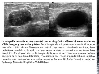 La ecografía mamaria es fundamental para el diagnóstico diferencial entre una lesión
sólida benigna y una lesión quística. En la imagen de la izquierda se presenta el aspecto
ecográfico clásico de un fibroadenoma: nódulo hipoecoico redondeado de 2 cm, bien
delimitado, paralelo a la piel, con leve refuerzo acústico posterior y un tenue halo
ecogénico. Por el contrario en la imagen de la derecha se presenta una masa ovalada
anecoica de 3 cms, bien delimitada, con paredes finas y con marcado refuerzo acústico
posterior que corresponde a un quiste mamario. Cortesía Dr. Rafael Salvador Unidad de
Radiología Mamaria. Hospital de Vall d´Hebrón.

 