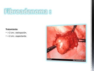 Tratamiento
 > 2 cm.: extirpación.
 < 2 cm.: expectante.

 