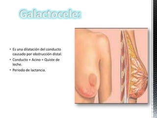 Es una dilatación del conducto
causado por obstrucción distal.
 Conducto + Acino = Quiste de
leche.
 Periodo de lactancia.

 