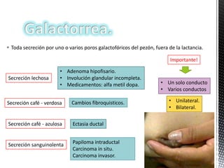  Toda secreción por uno o varios poros galactofóricos del pezón, fuera de la lactancia.
Importante!
Secreción lechosa

• Adenoma hipofisario.
• Involución glandular incompleta.
• Medicamentos: alfa metil dopa.

Secreción café - verdosa

Cambios fibroquisticos.

Secreción café - azulosa

Ectasia ductal

Secreción sanguinolenta

Papiloma intraductal
Carcinoma in situ.
Carcinoma invasor.

• Un solo conducto
• Varios conductos
• Unilateral.
• Bilateral.

 