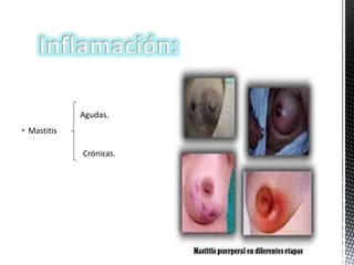 Agudas.
 Mastitis
Crónicas.

 