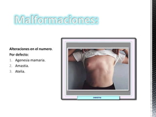 Alteraciones en el numero.
Por defecto:
1. Agenesia mamaria.
2. Amastia.
3. Atelia.

 