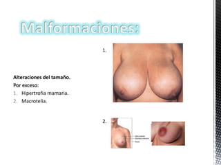 1.

Alteraciones del tamaño.
Por exceso:
1. Hipertrofia mamaria.
2. Macrotelia.

2.

 