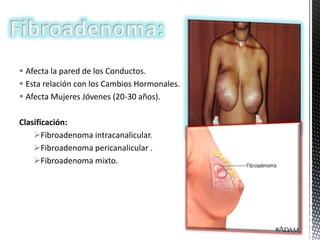  Afecta la pared de los Conductos.
 Esta relación con los Cambios Hormonales.
 Afecta Mujeres Jóvenes (20-30 años).
Clasificación:
Fibroadenoma intracanalicular.
Fibroadenoma pericanalicular .
Fibroadenoma mixto.

 