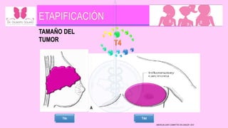 AMERICAN JOINT COMMITTEE ON CANCER • 2010
TAMAÑO DEL
TUMOR
T4a T4b
T4c T4d
 
