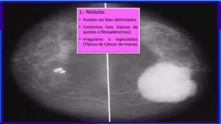 1.- Nódulos
• Pueden ser bien delimitados
• Contornos lisos (típicos de
quistes o fibroadenomas)
• Irregulares o espiculados
(Típicos de Cáncer de mama)
 