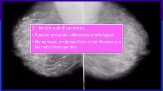2.- Micro calcificaciones
• Pueden presentar diferentes morfologías
• Numerosas, en líneas finas o ramificadas son
las más preocupantes
 