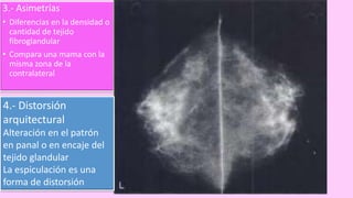 3.- Asimetrías
• Diferencias en la densidad o
cantidad de tejido
fibroglandular
• Compara una mama con la
misma zona de la
contralateral
4.- Distorsión
arquitectural
Alteración en el patrón
en panal o en encaje del
tejido glandular
La espiculación es una
forma de distorsión
 