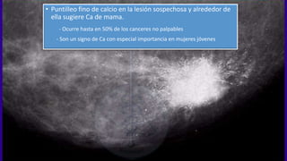 • Puntilleo fino de calcio en la lesión sospechosa y alrededor de
ella sugiere Ca de mama.
- Ocurre hasta en 50% de los canceres no palpables
- Son un signo de Ca con especial importancia en mujeres jóvenes
 