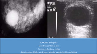 TUMORES benignas:
- Muestran contornos lisos
- Formas redondas u ovales
- Ecos internos débiles y márgenes anterior y posterior bien definidos
 