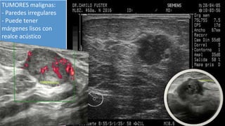 TUMORES malignas:
- Paredes irregulares
- Puede tener
márgenes lisos con
realce acústico
 