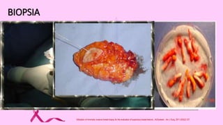 BIOPSIA
BAAF AGUJA DE CORTE VACUUM BX QUIRÚRGICA
Especificidad : 97%
Sensibilidad : 72-94%
Especificidad: 99%
Sensibilidad: 91%
Similar a aguja de corte
Alta sensibilidad
100%
FN: 0-32% Lesiones sólidos FN: 0.5 a 22% FN: 1.0%
Operador dependiente
No diferencia invasión
Complicaciones:
Múltiples punciones
Lesión de músculos,
intratorácica o periductal
Mayor sangrado
Riesgo de hematoma
Mayor volumen de tejido Fallas de 1.1%
Recomendada para
evaluación de ganglios
axilares
Quistes
DX e IHQ Mejores resultados
Biopsia de calcificaciones Costo
Anestesia.
cicatriz
Calibre de aguja: 22-25 g 11-14 g 9, 11, 14 g -
Utilization of minimally invasive breast biopsy for the evaluation of suspicious breast lesions., AUGutwein , Am J Surg. 2011;202(2):127.
 