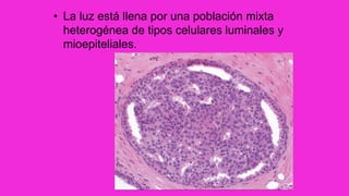 • La luz está llena por una población mixta
heterogénea de tipos celulares luminales y
mioepiteliales.
 