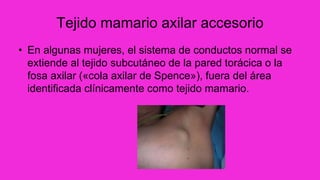 Tejido mamario axilar accesorio
• En algunas mujeres, el sistema de conductos normal se
extiende al tejido subcutáneo de la pared torácica o la
fosa axilar («cola axilar de Spence»), fuera del área
identificada clínicamente como tejido mamario.
 