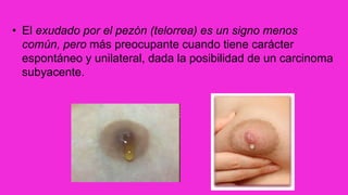 • El exudado por el pezón (telorrea) es un signo menos
común, pero más preocupante cuando tiene carácter
espontáneo y unilateral, dada la posibilidad de un carcinoma
subyacente.
 