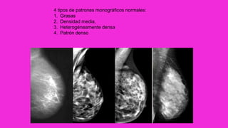 4 tipos de patrones monográficos normales:
1. Grasas
2. Densidad media,
3. Heterogéneamente densa
4. Patrón denso
 
