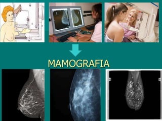 MAMOGRAFIA
 