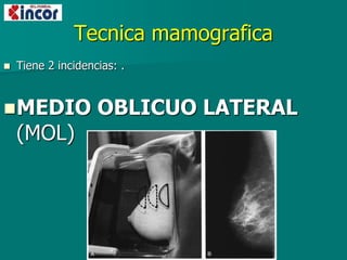 Tecnica mamografica
 Tiene 2 incidencias: .
MEDIO OBLICUO LATERAL
(MOL)
 