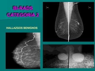 BI-RADS
CATEGORIA 2
HALLAZGOS BENIGNOS
 
