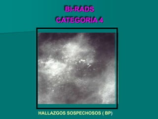 BI-RADS
CATEGORIA 4
HALLAZGOS SOSPECHOSOS ( BP)
 