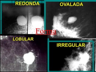 REDONDA OVALADA
LOBULAR
IRREGULAR
Forma
 