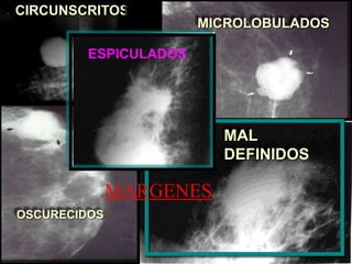 Márgenes:
CIRCUNSCRITOS
MICROLOBULADOS
OSCURECIDOS
MAL
DEFINIDOS
MARGENES
ESPICULADOS
 
