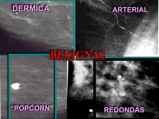 DERMICA ARTERIAL
“POPCORN” REDONDAS
BENIGNAS
 