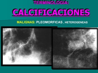TERMINOLOGIA:
CALCIFICACIONES
MALIGNAS: PLEOMORFICAS , HETEROGENEAS
 