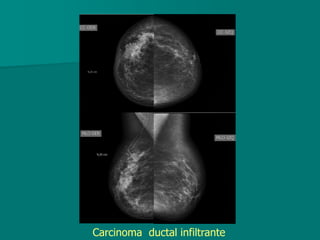 Carcinoma ductal infiltrante
 