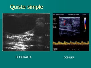 Quiste simple
ECOGRAFIA DOPPLER
 
