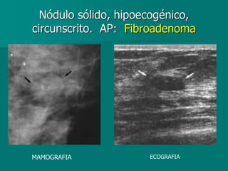Nódulo sólido, hipoecogénico,
circunscrito. AP: Fibroadenoma
MAMOGRAFIA ECOGRAFIA
 