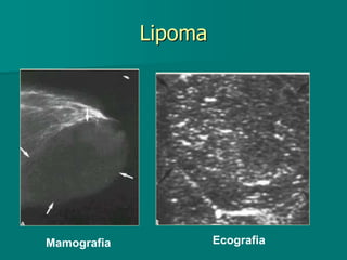 Lipoma
Mamografia Ecografia
 